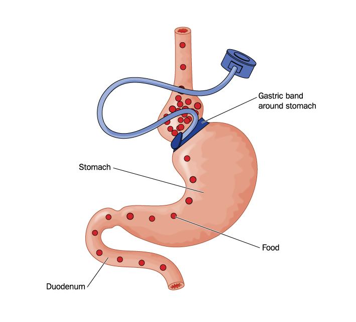 Requirements for lap band surgery